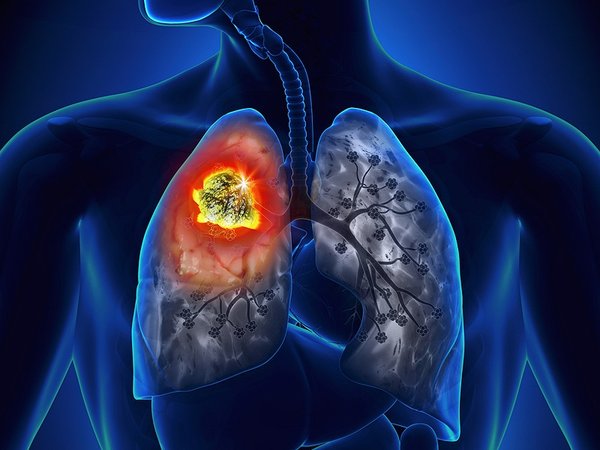 Ung thư phổi nguy hiểm đến sức khỏe 