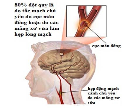 Tai biến mạch máu não xảy ra khi mạch não bị tắc